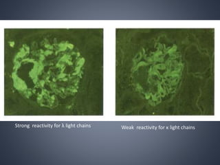 Strong reactivity for λ light chains Weak reactivity for κ light chains
 