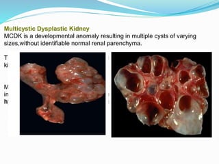 Mcdk Ras Renal anomalies | PPTX
