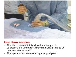 Renal biopsy procedure
• The biopsy needle is introduced at an angle of
approximately 70 degrees to the skin and is guided by
continuous ultrasound.
• The operator is shown wearing a surgical gown.
 
