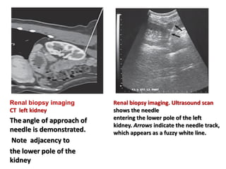 Renal biopsy imaging. Ultrasound scan
shows the needle
entering the lower pole of the left
kidney. Arrows indicate the needle track,
which appears as a fuzzy white line.
Renal biopsy imaging
CT left kidney
The angle of approach of
needle is demonstrated.
Note adjacency to
the lower pole of the
kidney
 