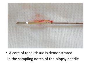 • A core of renal tissue is demonstrated
in the sampling notch of the biopsy needle
 
