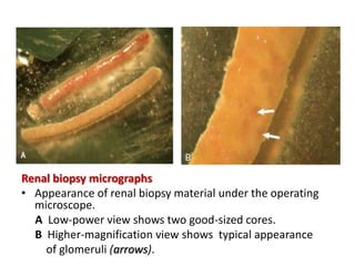 Renal biopsy micrographs
• Appearance of renal biopsy material under the operating
microscope.
A Low-power view shows two good-sized cores.
B Higher-magnification view shows typical appearance
of glomeruli (arrows).
 