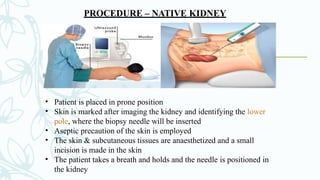 PROCEDURE – NATIVE KIDNEY
• Patient is placed in prone position
• Skin is marked after imaging the kidney and identifying the lower
pole, where the biopsy needle will be inserted
• Aseptic precaution of the skin is employed
• The skin & subcutaneous tissues are anaesthetized and a small
incision is made in the skin
• The patient takes a breath and holds and the needle is positioned in
the kidney
 
