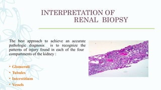 INTERPRETATION OF
RENAL BIOPSY
The best approach to achieve an accurate
pathologic diagnosis is to recognize the
patterns of injury found in each of the four
compartments of the kidney :
• Glomeruli
• Tubules
• Interstitium
• Vessels
 