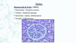 Stains
Hematoxylin & Eosin : (H&E)
• Glomerular : Exudative lesions
• Tubular : Epithelial damage
• Interstitial : Edema, Inflammation
• Vascular : Inflammation
 