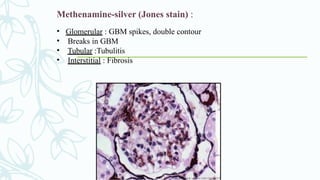 Methenamine-silver (Jones stain) :
• Glomerular : GBM spikes, double contour
• Breaks in GBM
• Tubular :Tubulitis
• Interstitial : Fibrosis
 