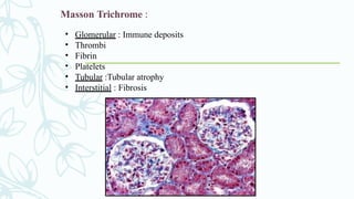 Masson Trichrome :
• Glomerular : Immune deposits
• Thrombi
• Fibrin
• Platelets
• Tubular :Tubular atrophy
• Interstitial : Fibrosis
 