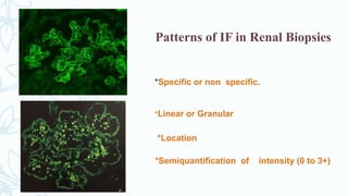 Patterns of IF in Renal Biopsies
*Specific or non specific.
*Linear or Granular
*Location
*Semiquantification of intensity (0 to 3+)
 