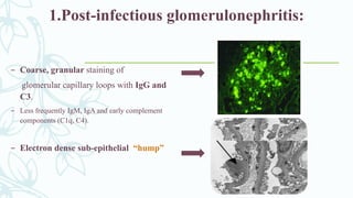 – Coarse, granular staining of
glomerular capillary loops with IgG and
C3.
– Less frequently IgM, IgA and early complement
components (C1q, C4).
– Electron dense sub-epithelial “hump”
1.Post-infectious glomerulonephritis:
 
