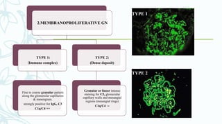 2.MEMBRANOPROLIFERATIVE GN
TYPE 1:
(Immune complex)
Fine to coarse granular pattern
along the glomerular capillaries
& mesengium.
strongly positive for IgG, C3
C1q/C4 ++
TYPE 2:
(Dense deposit)
Granular or linear intense
staining for C3, glomerular
capillary walls and mesangial
regions (mesangial rings)
C1q/C4 --
TYPE 1
TYPE 2
 