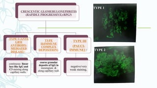 CRESCENTIC GLOMERULONEPHRITIS
(RAPIDLY PROGRESSIVE)-RPGN
.TYPE I (ANTI-
GBM
ANTIBODY-
MEDIATED
DISEASE) :
continuous linear
lace like IgG and
C3 staining along
capillary walls.
TYPE
II(IMMUNE
COMPLEX
DEPOSITION)
coarse granular
deposits of IgG in
mesengium &
along capillary wall.
. TYPE III
(PAUCI-
IMMUNE) :
negative/very
weak staining,
TYPE 1
TYPE 2
 