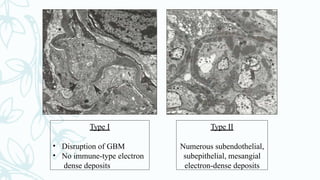 Type I
• Disruption of GBM
• No immune-type electron
dense deposits
Type II
Numerous subendothelial,
subepithelial, mesangial
electron-dense deposits
 