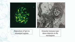 Deposition of IgA in
mesangial regions
Granular immune-type
dense deposits in the
mesangium
 