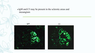 • IgM and C3 may be present in the sclerotic areas and
mesangium
IgM C3
 