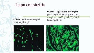 Lupus nephritis
• Class I:delicate mesangial
positivity for IgG
• Class II : granular mesangial
positivity of all three Ig and both
complements (C1q and C3) (“full
house” pattern)
 