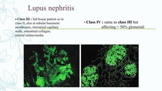 Lupus nephritis
• Class III : full house pattern as in
class II, also in tubular basement
membranes, interstitial capillary
walls, interstitial collagen,
arterial intima/media.
• Class IV : same as class III but
affecting > 50% glomeruli
 