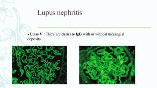 Lupus nephritis
• Class V : There are delicate IgG with or without mesangial
deposits
 