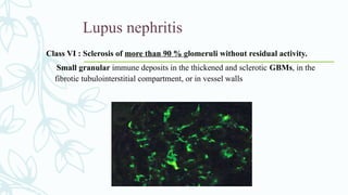 Class VI : Sclerosis of more than 90 % glomeruli without residual activity.
Small granular immune deposits in the thickened and sclerotic GBMs, in the
fibrotic tubulointerstitial compartment, or in vessel walls
Lupus nephritis
 