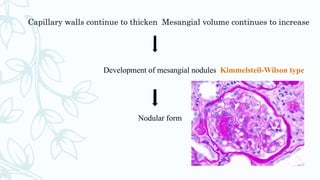 Capillary walls continue to thicken Mesangial volume continues to increase
Development of mesangial nodules Kimmelsteil-Wilson type
Nodular form
 