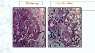 Fibrin cap Capsular drop
 