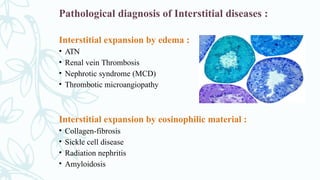 Pathological diagnosis of Interstitial diseases :
Interstitial expansion by edema :
• ATN
• Renal vein Thrombosis
• Nephrotic syndrome (MCD)
• Thrombotic microangiopathy
Interstitial expansion by eosinophilic material :
• Collagen-fibrosis
• Sickle cell disease
• Radiation nephritis
• Amyloidosis
 