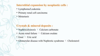 Interstitial expansion by neoplastic cells :
• Lymphoma/Leukemia
• Primary renal cell carcinoma
• Metastasis
Crystals & mineral deposits :
• Nephrocalcinosis  Calcium carbonate
• Acute renal failure  Calcium oxalate
• Gout  Uric acid
• Glomerular disease with Nephrotic syndrome  Cholesterol
 