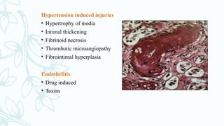Hypertension induced injuries
• Hypertrophy of media
• Intimal thickening
• Fibrinoid necrosis
• Thrombotic microangiopathy
• Fibrointimal hyperplasia
Endothelitis
• Drug induced
• Toxins
 