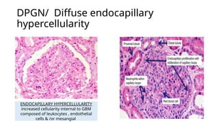 Comprehensive Guide to Renal Biopsy: Techniques and Pathology | PPTX