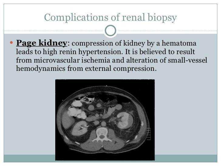 Renal biopsy seminar