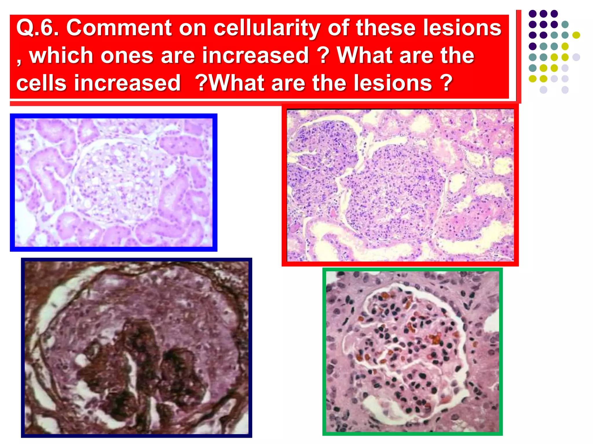 Q.6. Comment on cellularity of these lesions
, which ones are increased ? What are the
cells increased ?What are the lesions ?
 