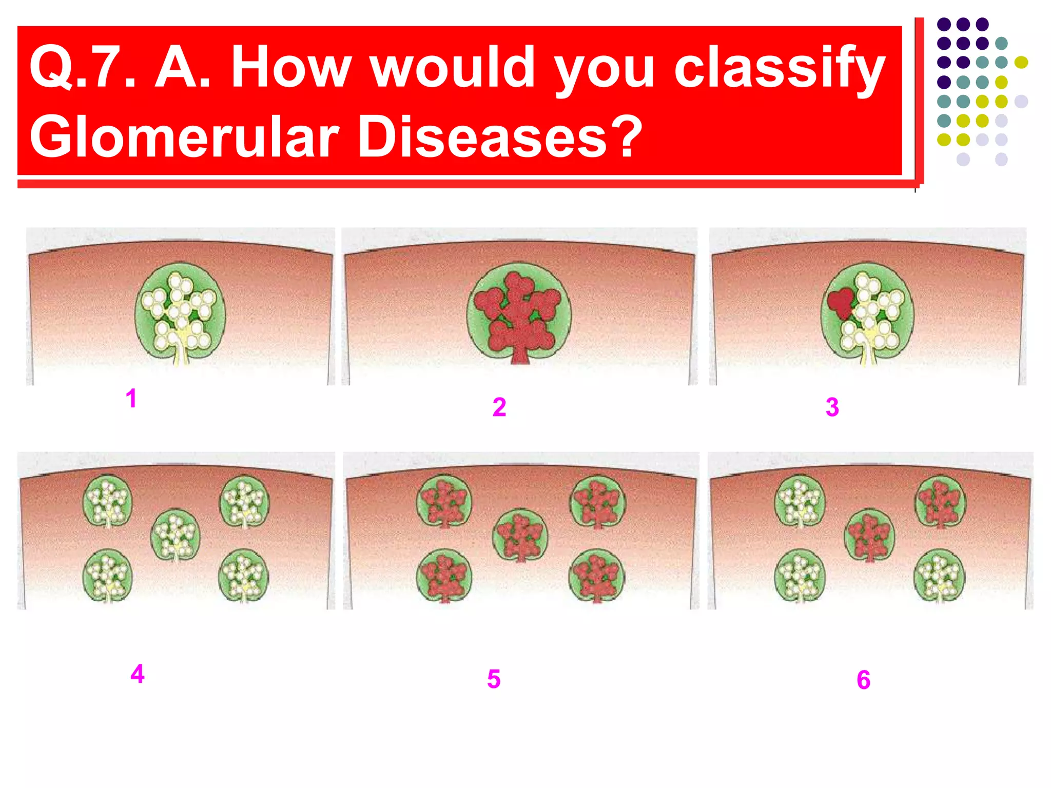 Q.7. A. How would you classify
Glomerular Diseases?
1 2 3
4 5 6
 