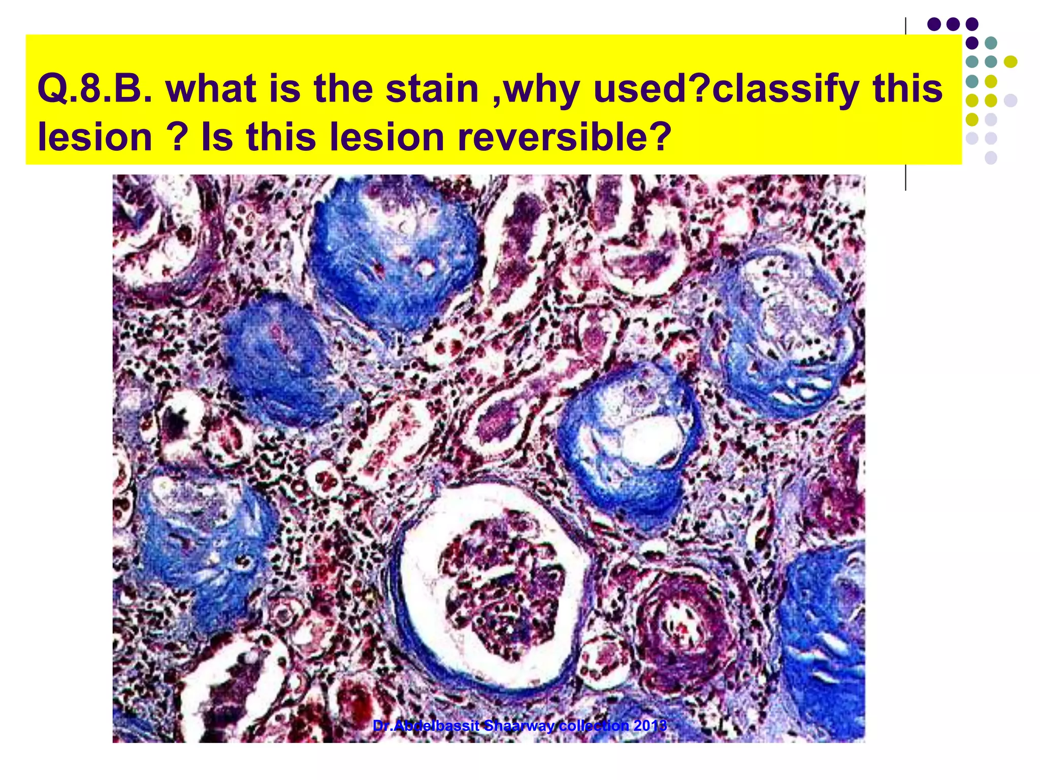 Q.8.B. what is the stain ,why used?classify this
lesion ? Is this lesion reversible?
Dr.Abdelbassit Shaarway collection 2013
 