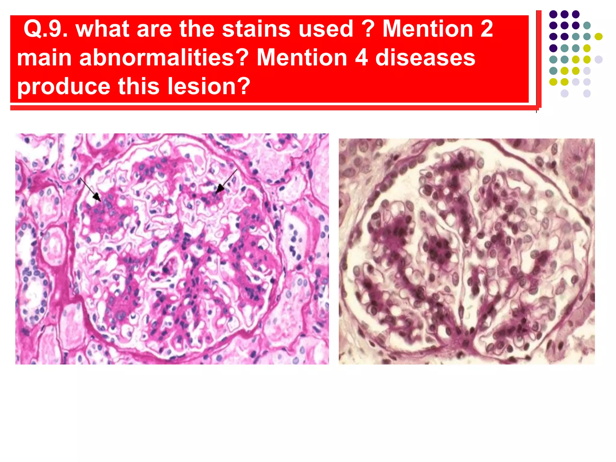 Q.9. what are the stains used ? Mention 2
main abnormalities? Mention 4 diseases
produce this lesion?
 
