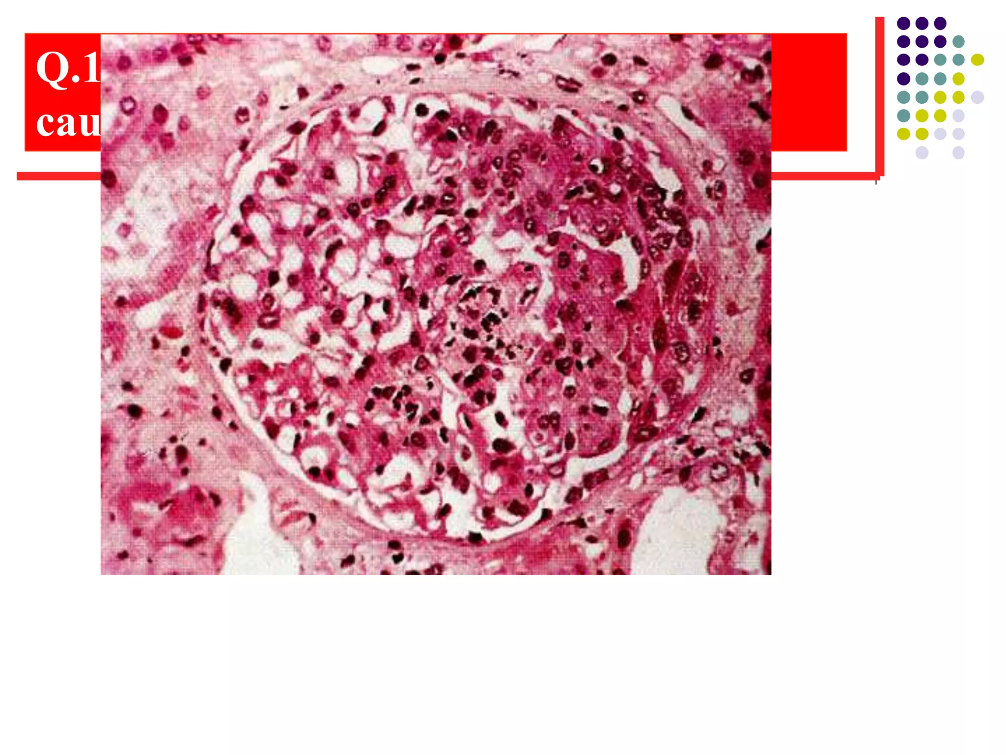 Q.10. What is the lesion? Mention 2
causes of it
 