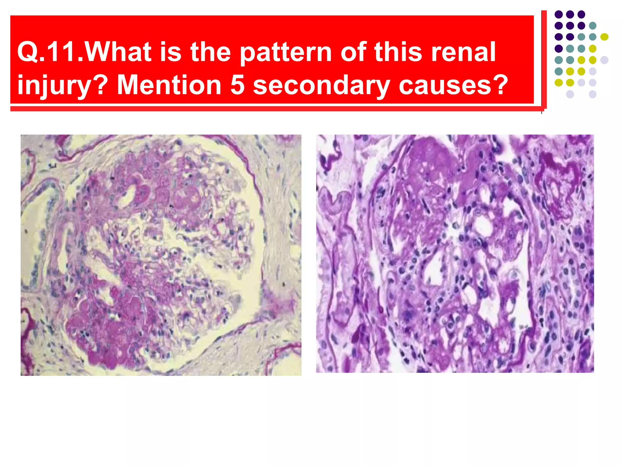 Q.11.What is the pattern of this renal
injury? Mention 5 secondary causes?
 