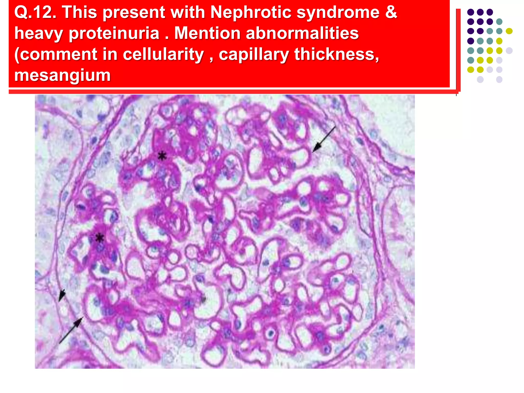 Q.12. This present with Nephrotic syndrome &
heavy proteinuria . Mention abnormalities
(comment in cellularity , capillary thickness,
mesangium
 