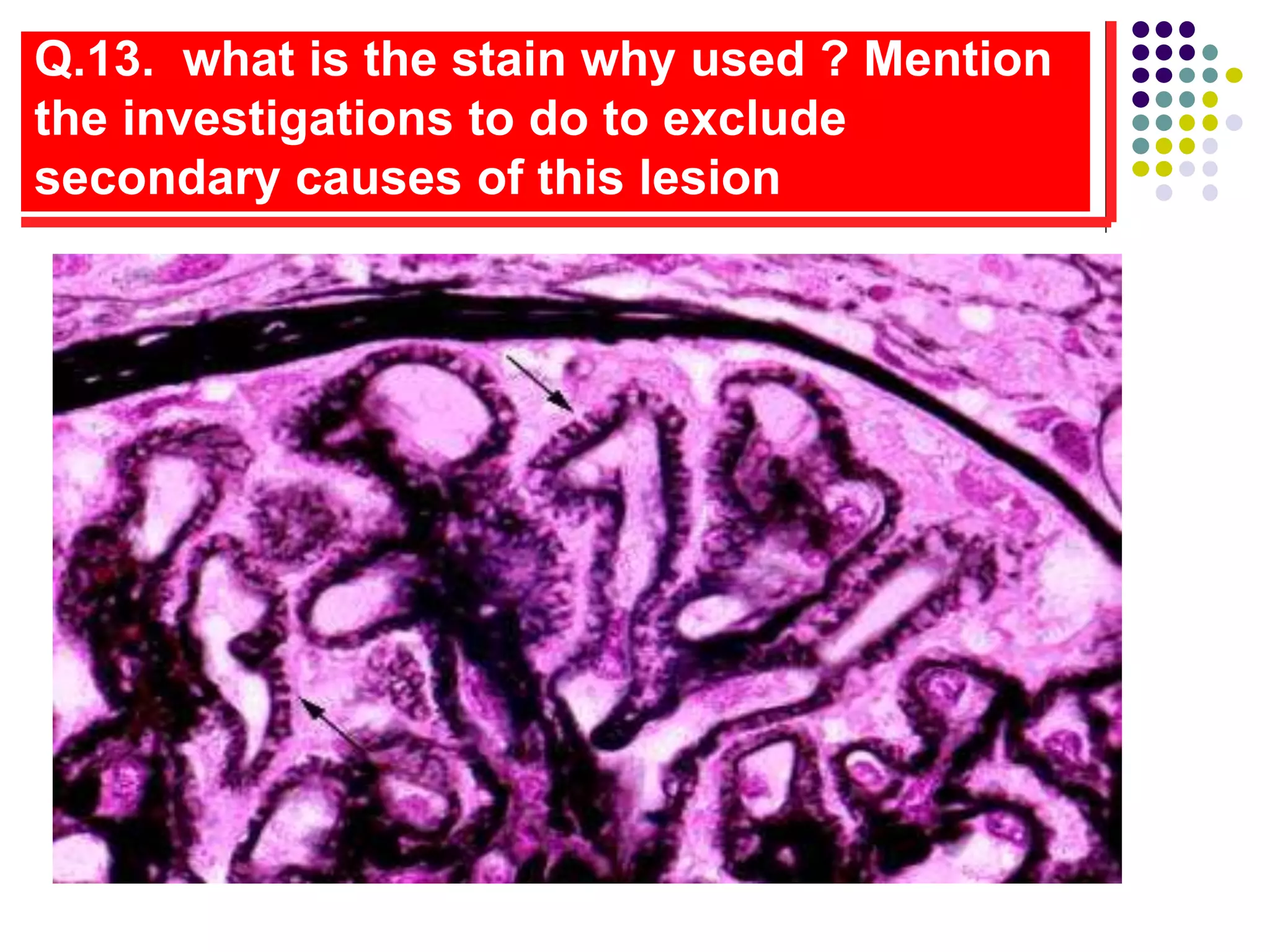Q.13. what is the stain why used ? Mention
the investigations to do to exclude
secondary causes of this lesion
 