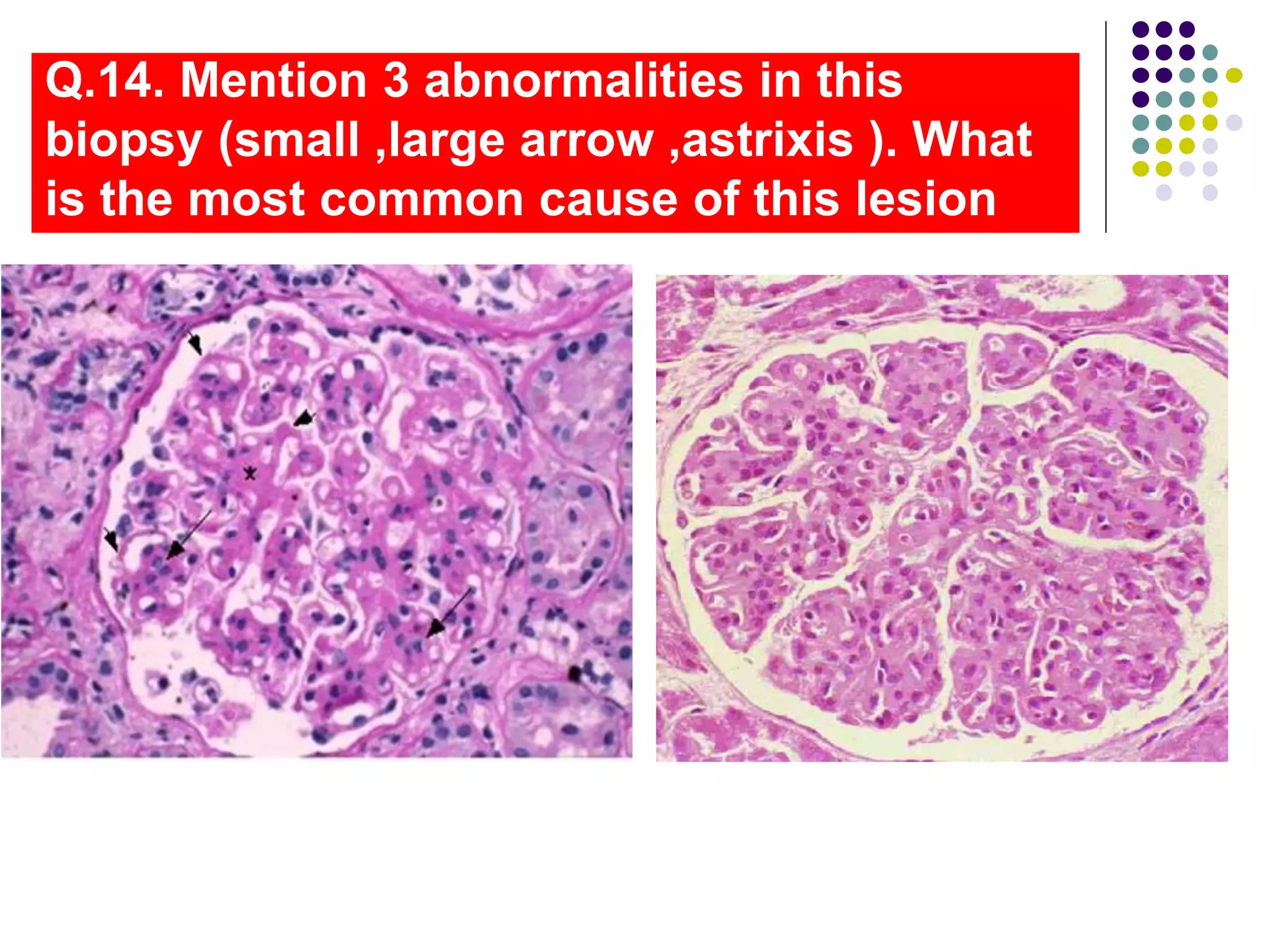 Q.14. Mention 3 abnormalities in this
biopsy (small ,large arrow ,astrixis ). What
is the most common cause of this lesion
 