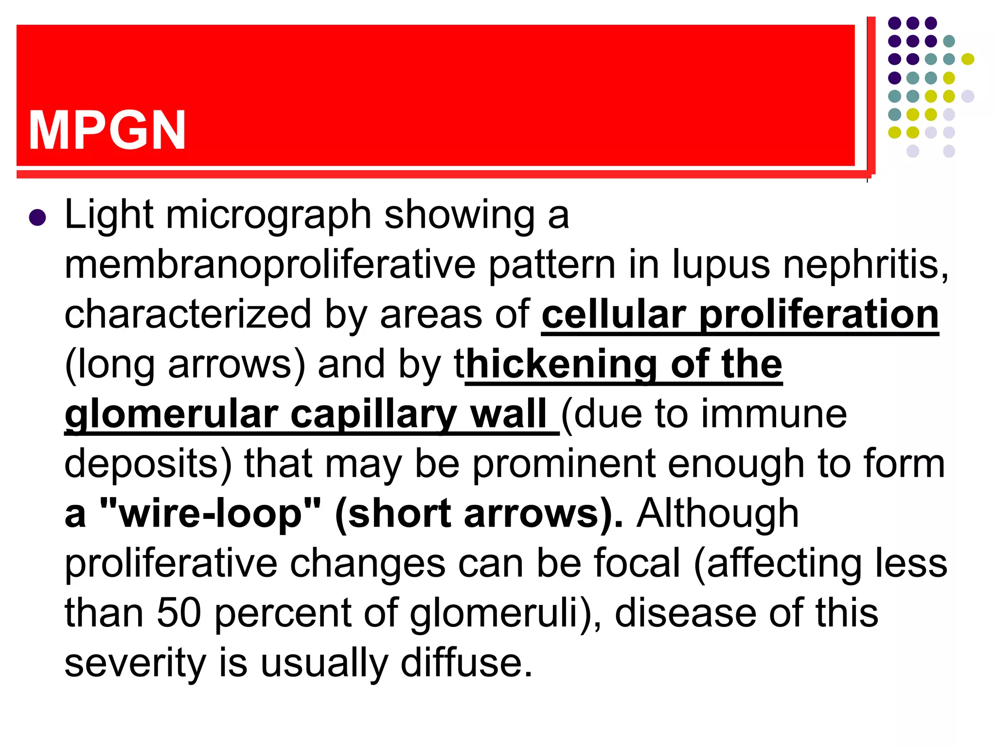 MPGN
 Light micrograph showing a
membranoproliferative pattern in lupus nephritis,
characterized by areas of cellular proliferation
(long arrows) and by thickening of the
glomerular capillary wall (due to immune
deposits) that may be prominent enough to form
a "wire-loop" (short arrows). Although
proliferative changes can be focal (affecting less
than 50 percent of glomeruli), disease of this
severity is usually diffuse.
 