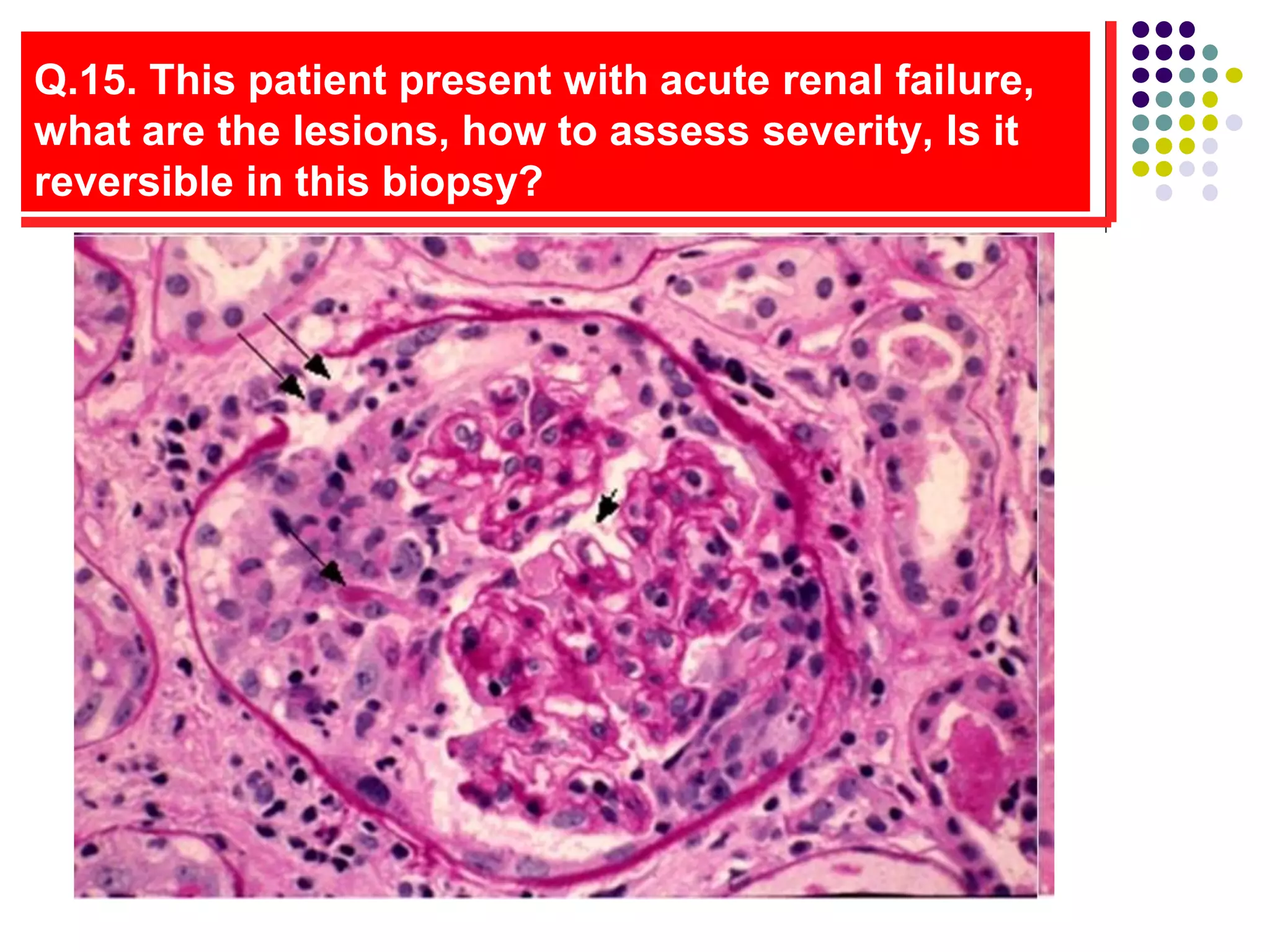 Q.15. This patient present with acute renal failure,
what are the lesions, how to assess severity, Is it
reversible in this biopsy?
 