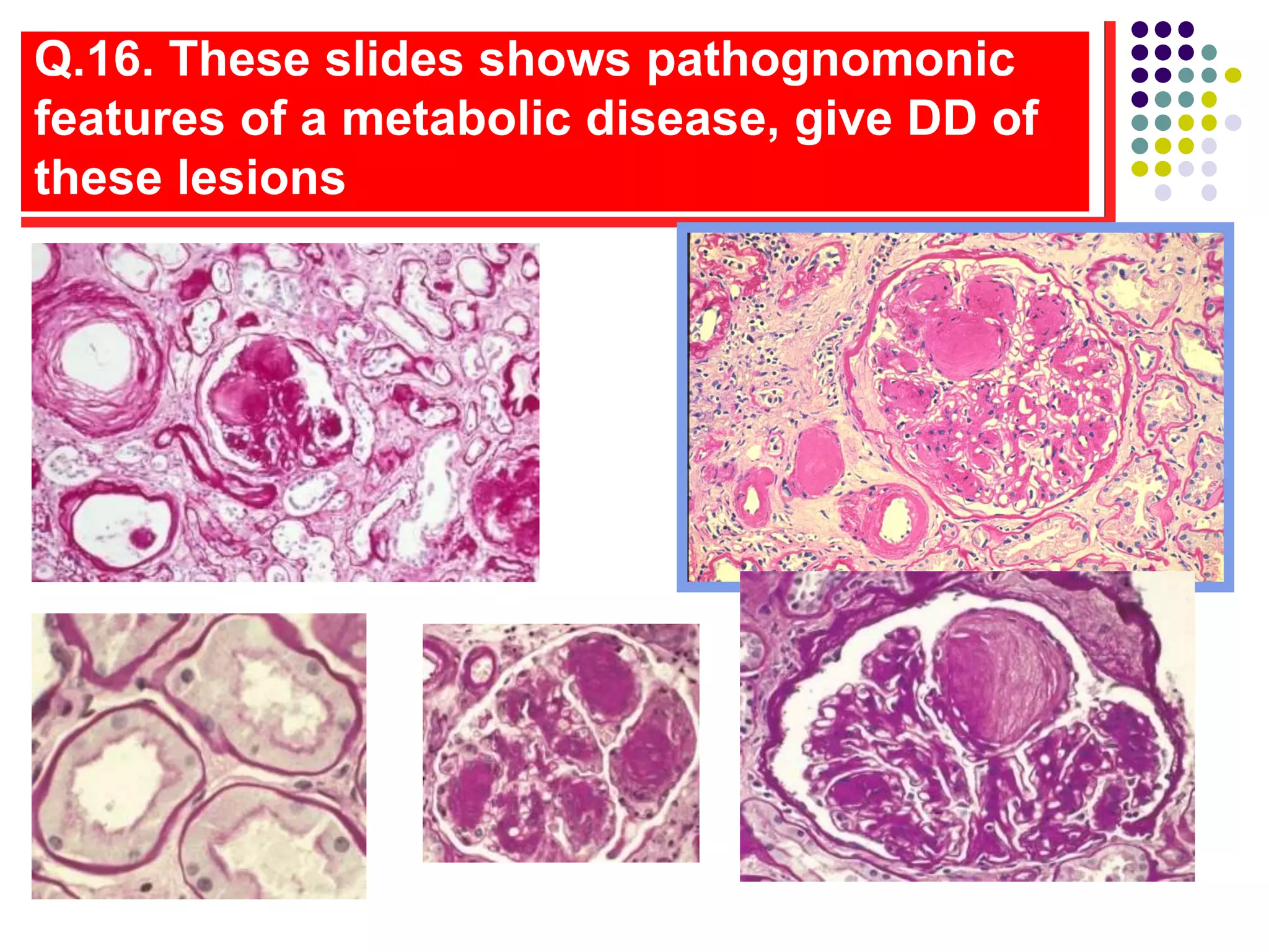 Q.16. These slides shows pathognomonic
features of a metabolic disease, give DD of
these lesions
 