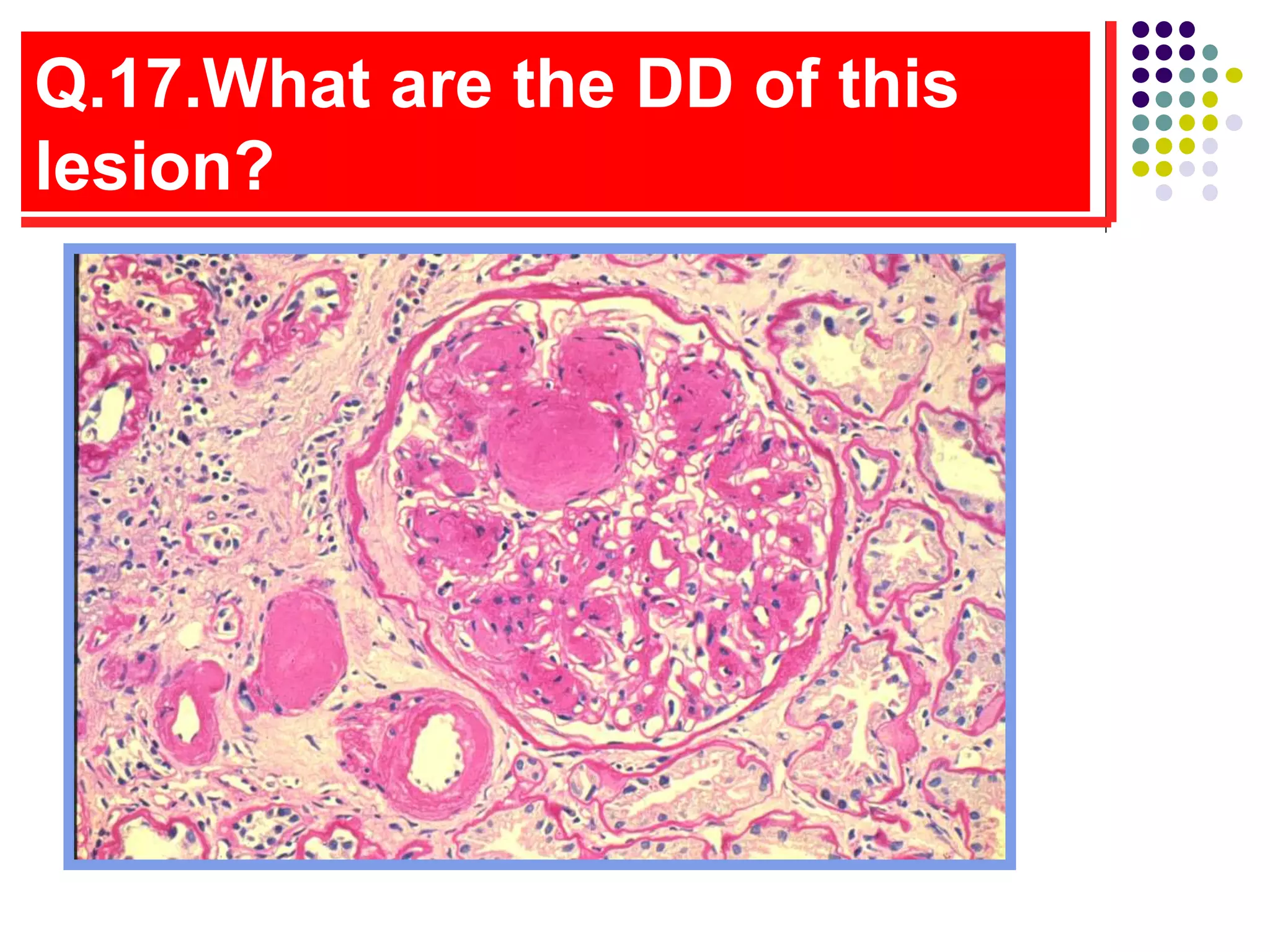 Q.17.What are the DD of this
lesion?
 