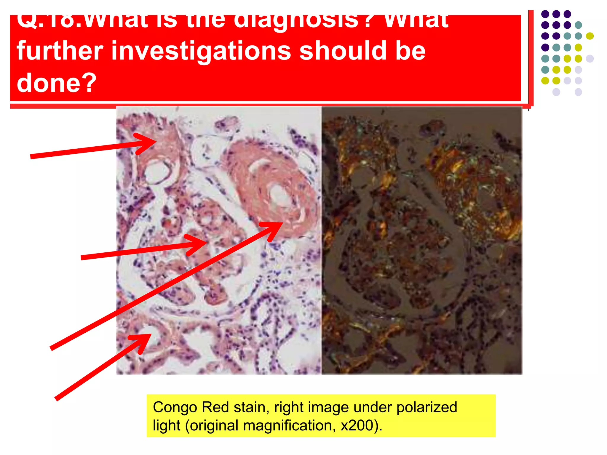 Q.18.What is the diagnosis? What
further investigations should be
done?
Congo Red stain, right image under polarized
light (original magnification, x200).
 