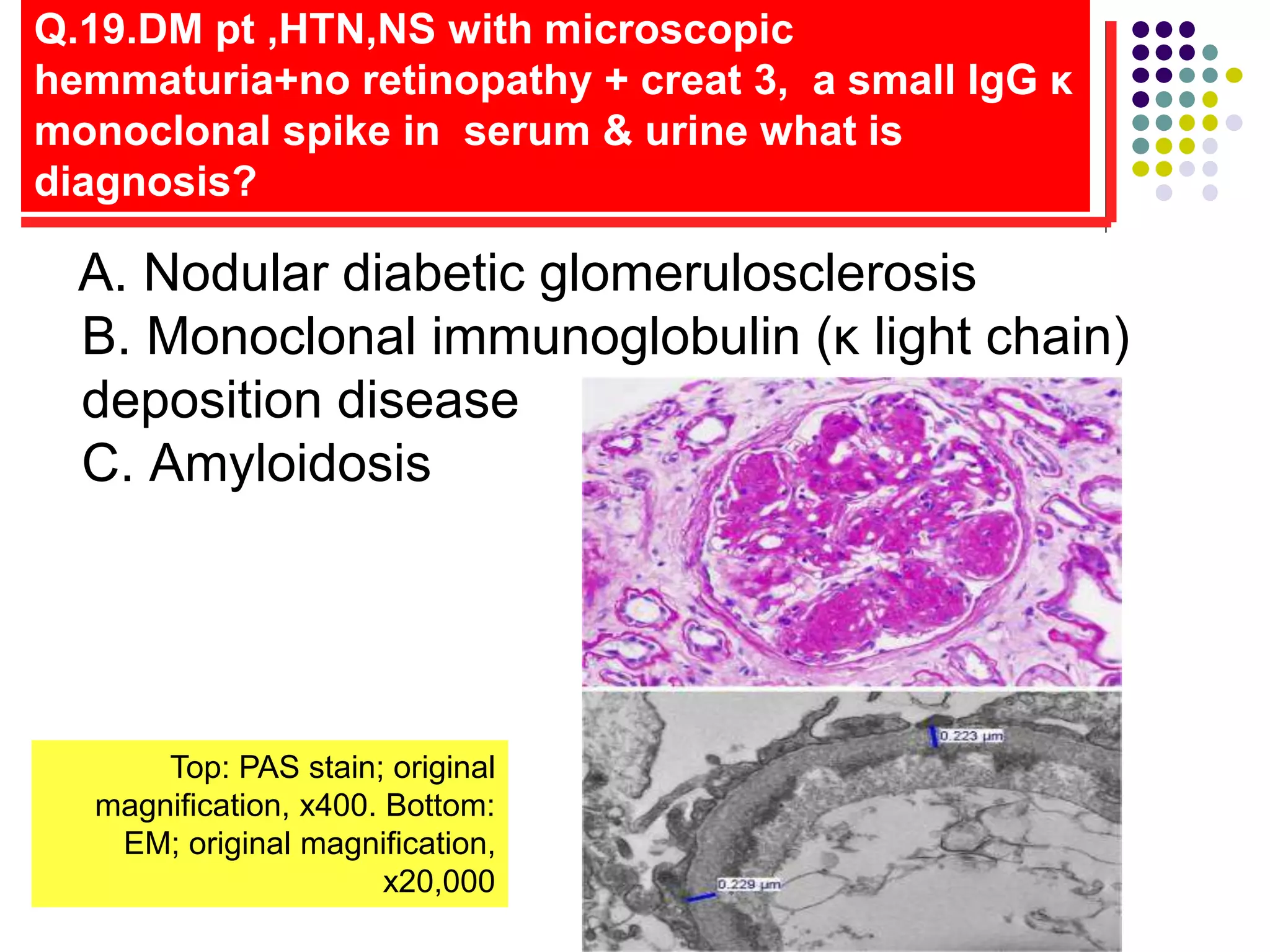 Q.19.DM pt ,HTN,NS with microscopic
hemmaturia+no retinopathy + creat 3, a small IgG κ
monoclonal spike in serum & urine what is
diagnosis?
A. Nodular diabetic glomerulosclerosis
B. Monoclonal immunoglobulin (κ light chain)
deposition disease
C. Amyloidosis
Top: PAS stain; original
magnification, x400. Bottom:
EM; original magnification,
x20,000
 
