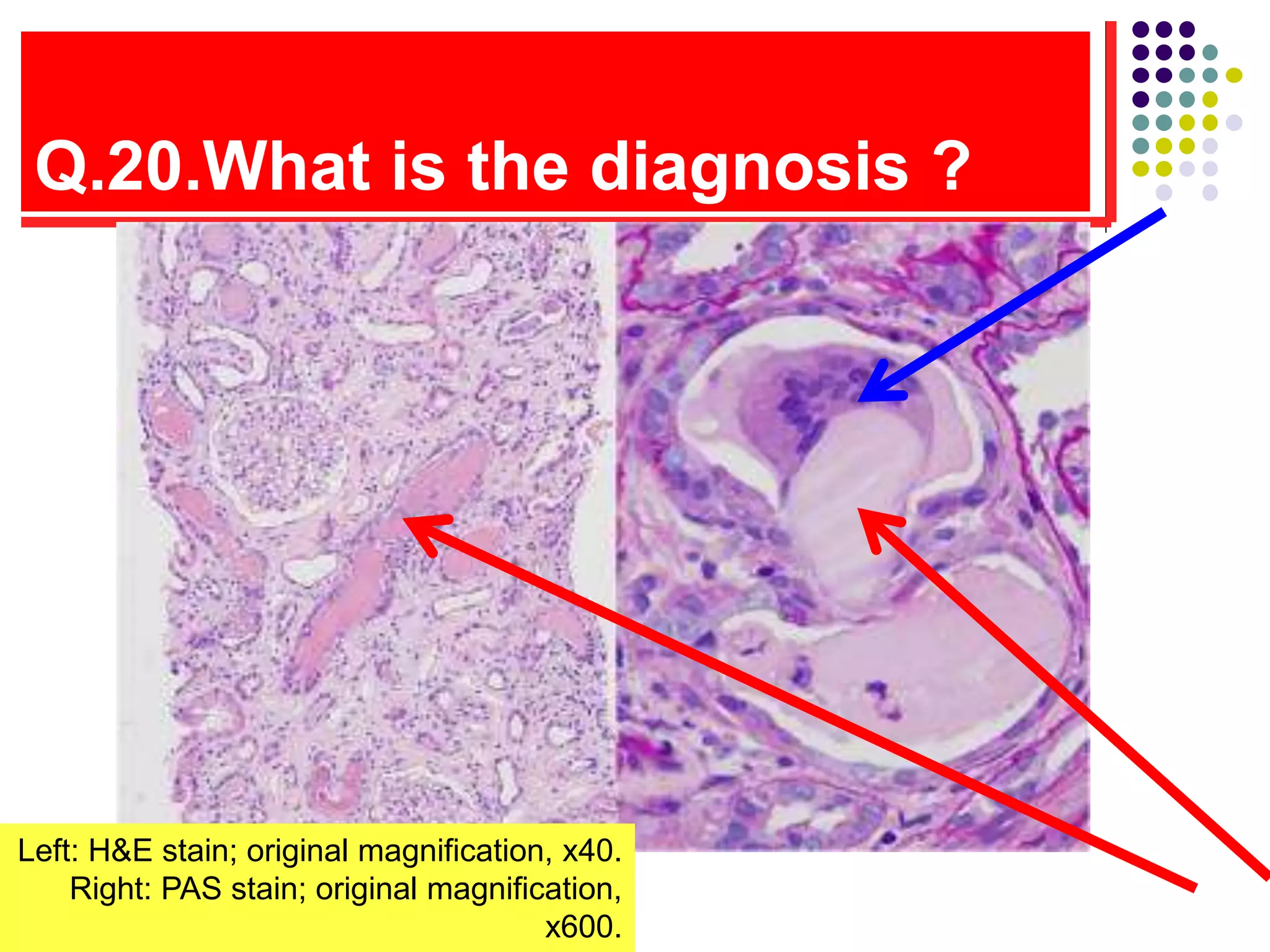 Q.20.What is the diagnosis ?
Left: H&E stain; original magnification, x40.
Right: PAS stain; original magnification,
x600.
 