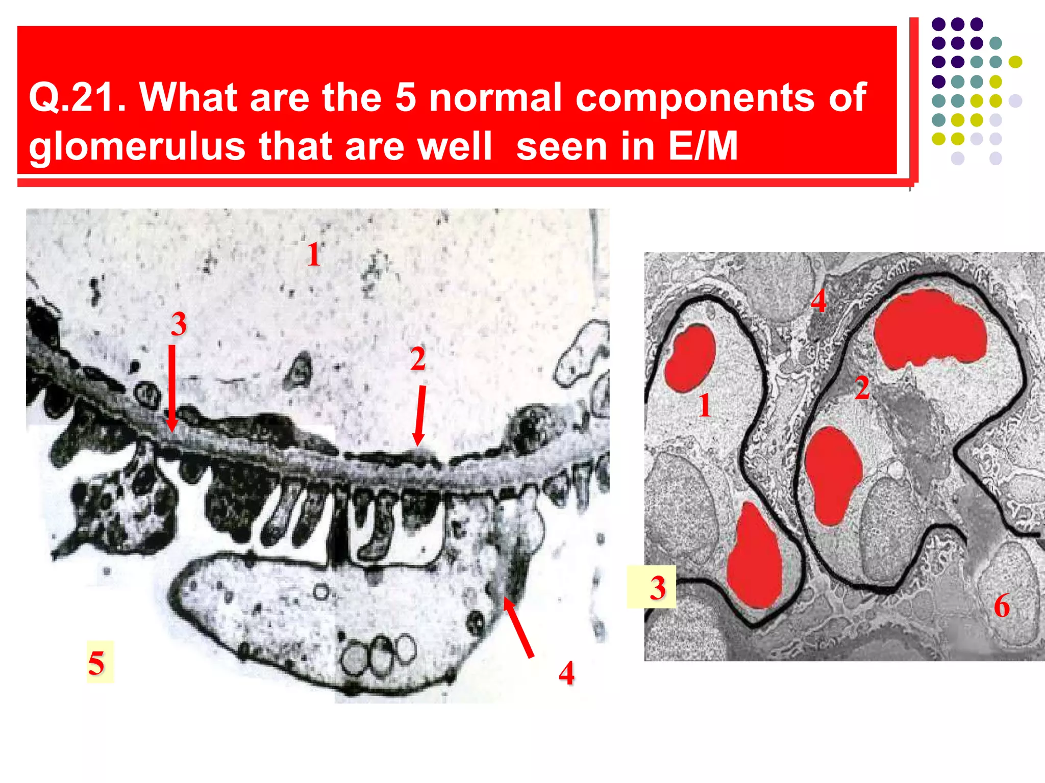 Q.21. What are the 5 normal components of
glomerulus that are well seen in E/M
1
2
5
3
4
3
2
1
4
6
 