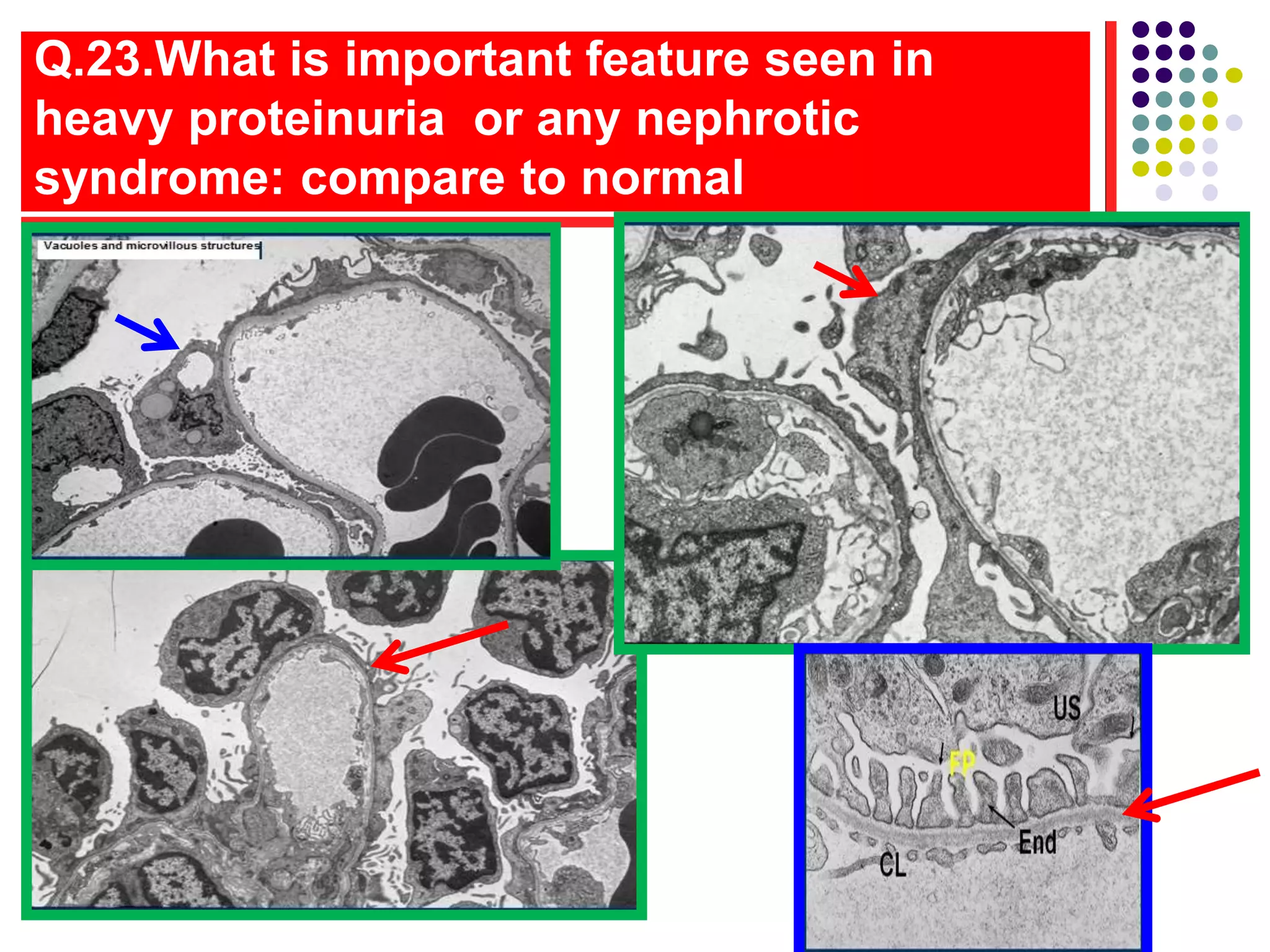 Q.23.What is important feature seen in
heavy proteinuria or any nephrotic
syndrome: compare to normal
 