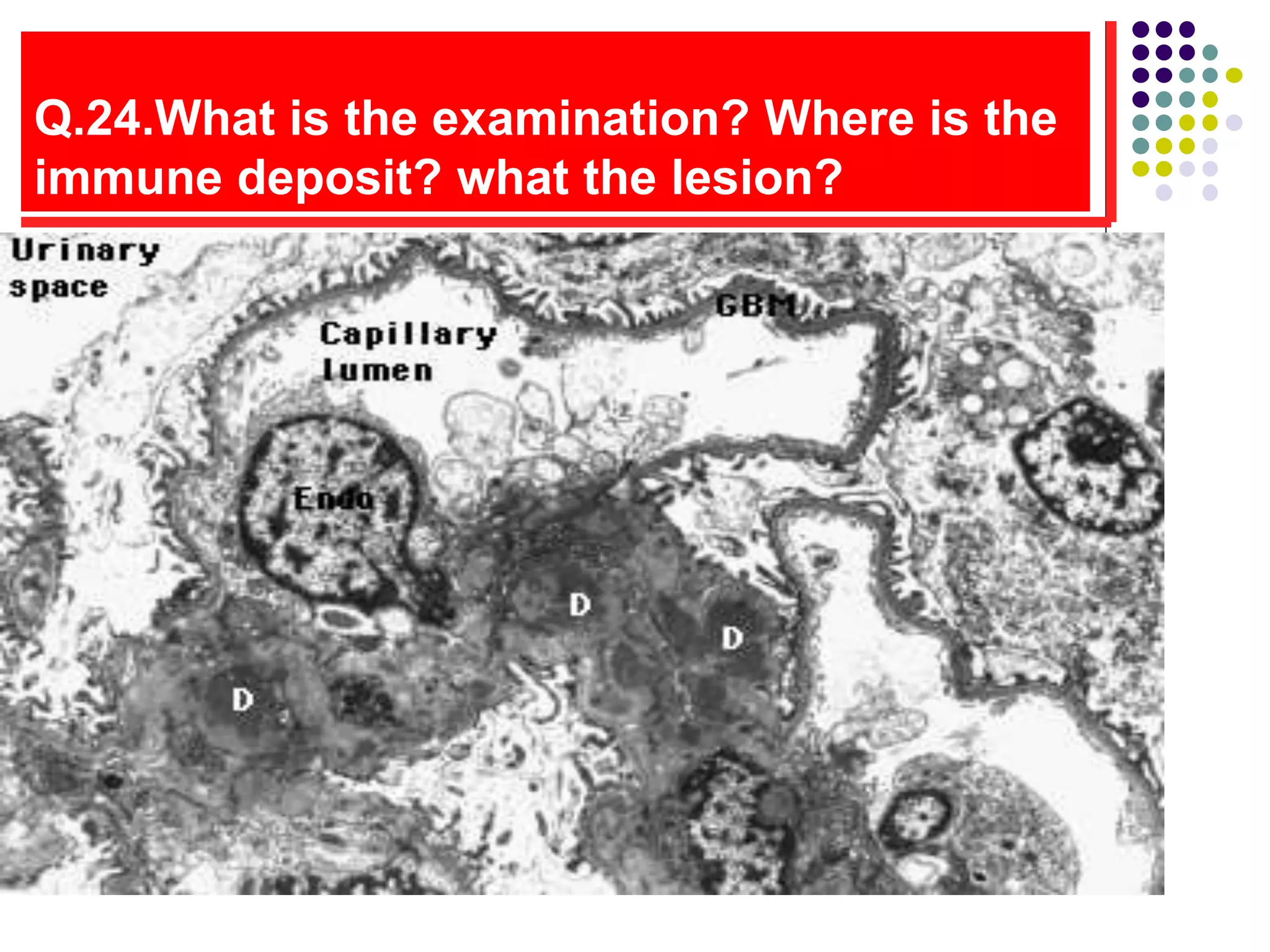 Q.24.What is the examination? Where is the
immune deposit? what the lesion?
 