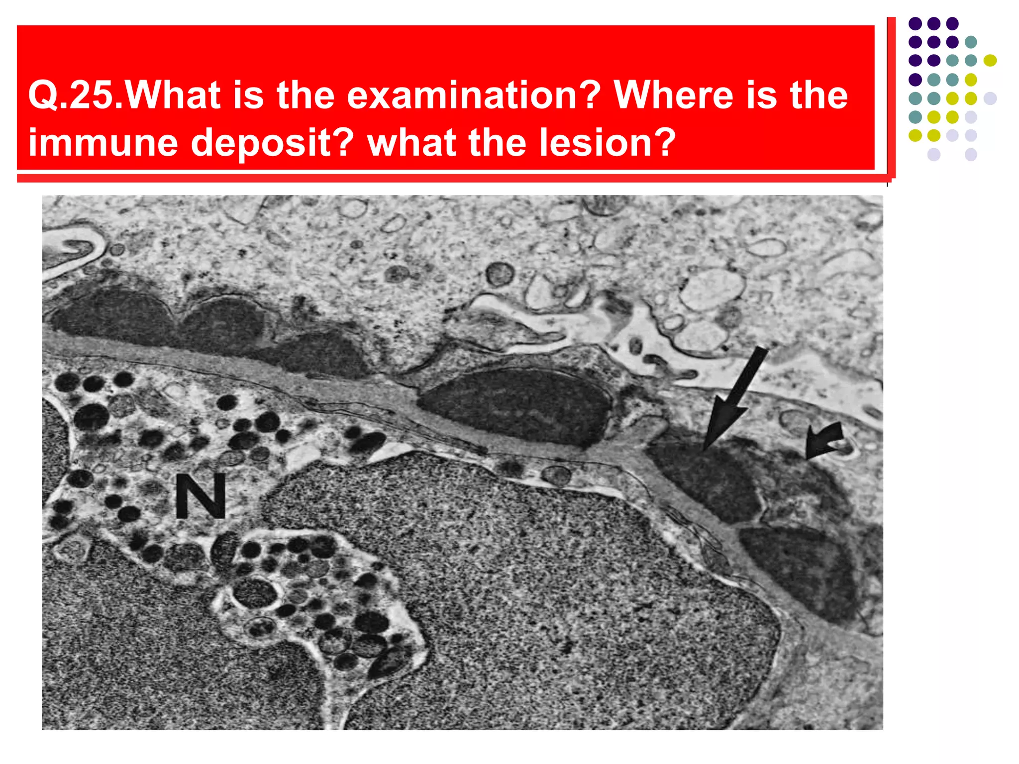 Q.25.What is the examination? Where is the
immune deposit? what the lesion?
 