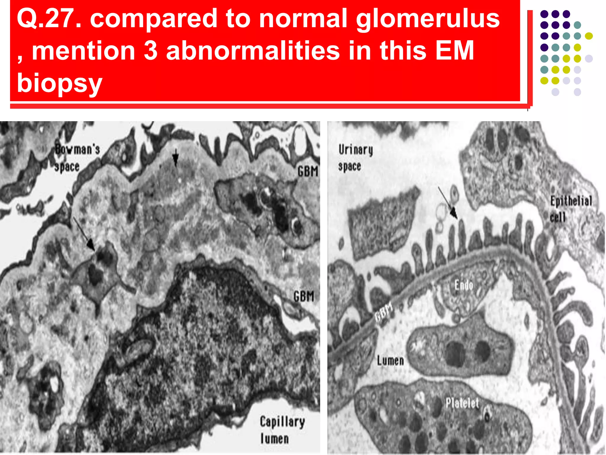 Q.27. compared to normal glomerulus
, mention 3 abnormalities in this EM
biopsy
 